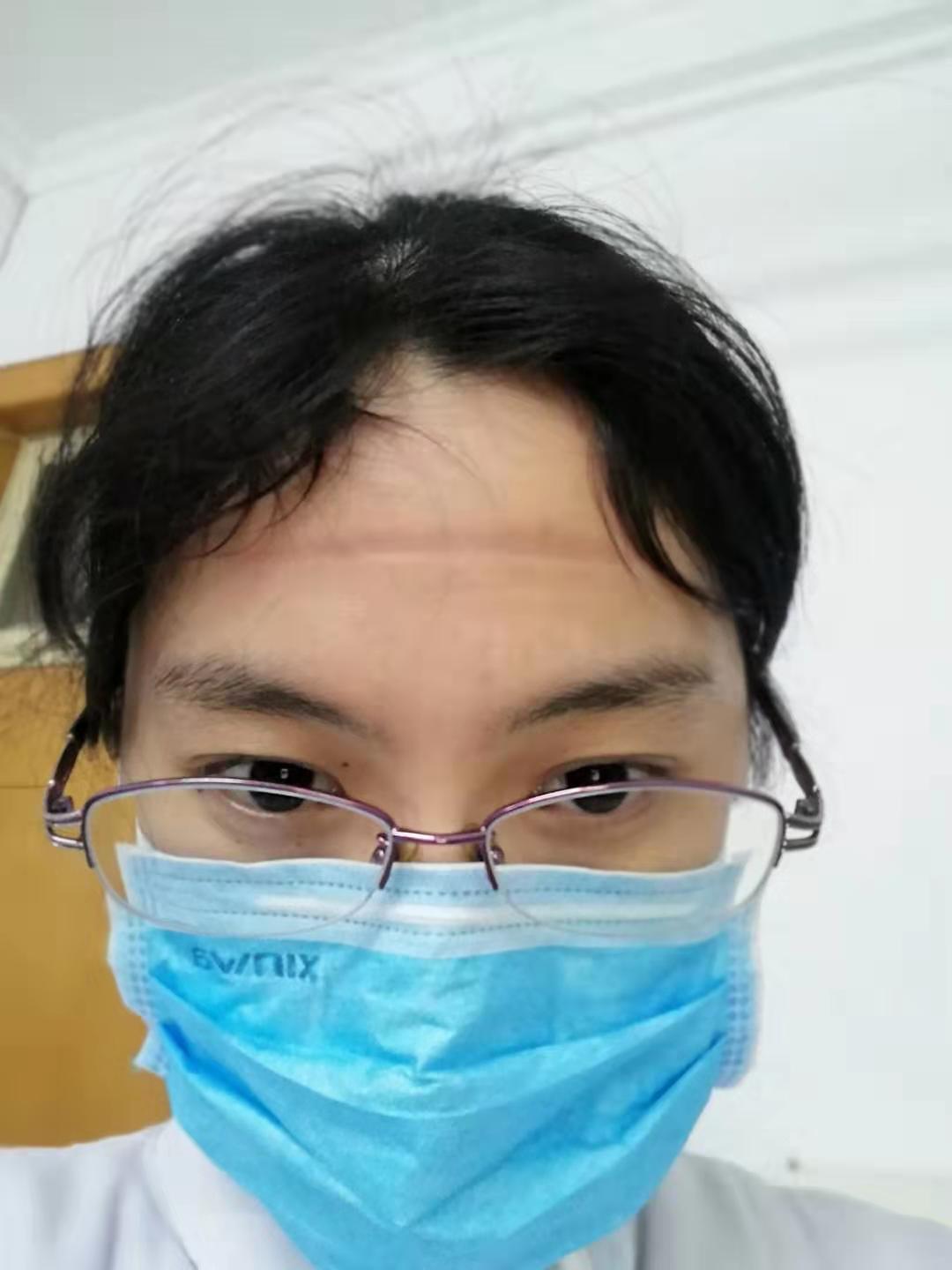 發(fā)熱門診值班護士,戴護目鏡6個多小時壓在額頭上的痕跡.jpg 發(fā)熱門診值班護士,戴護目鏡6個多小時壓在額頭上的痕跡.jpg